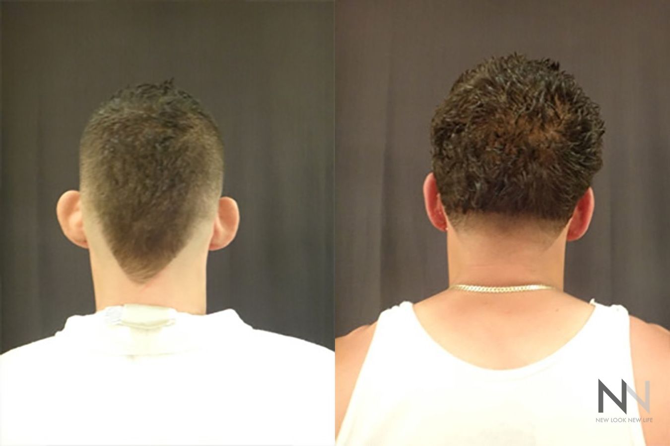 Ear pinning surgery showing reduced ear protrusion