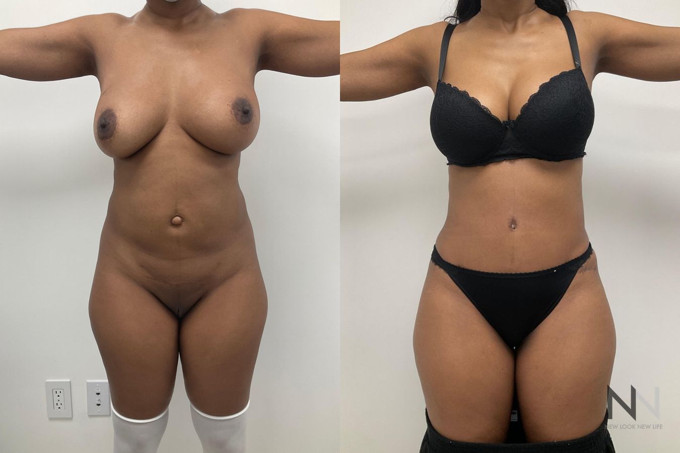 Abdominoplasty and liposuction showing improved contour
