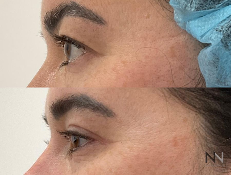 Before and after upper blepharoplasty three months results - Angle 3