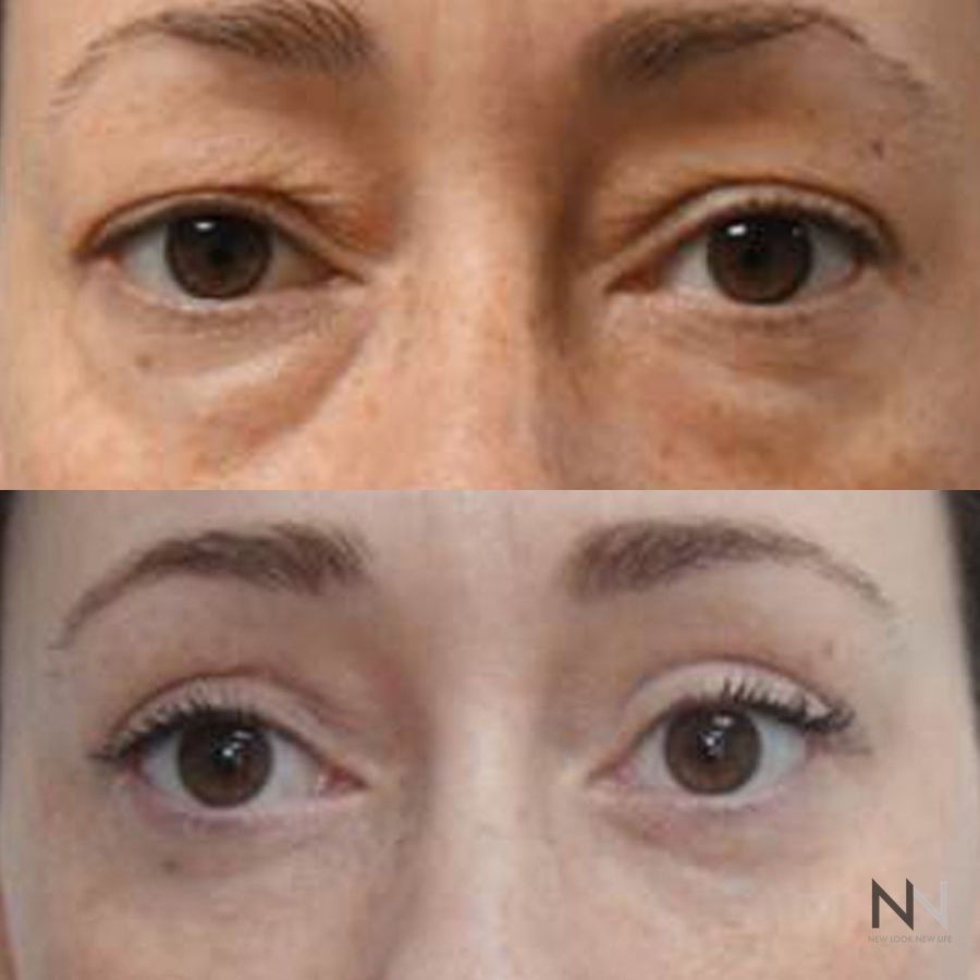 Eyelid surgery showing reduced sagging and under-eye bags