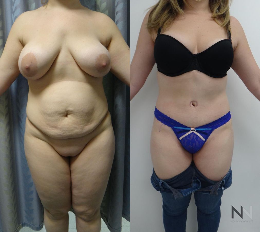 Midsection contour refinement after abdominoplasty