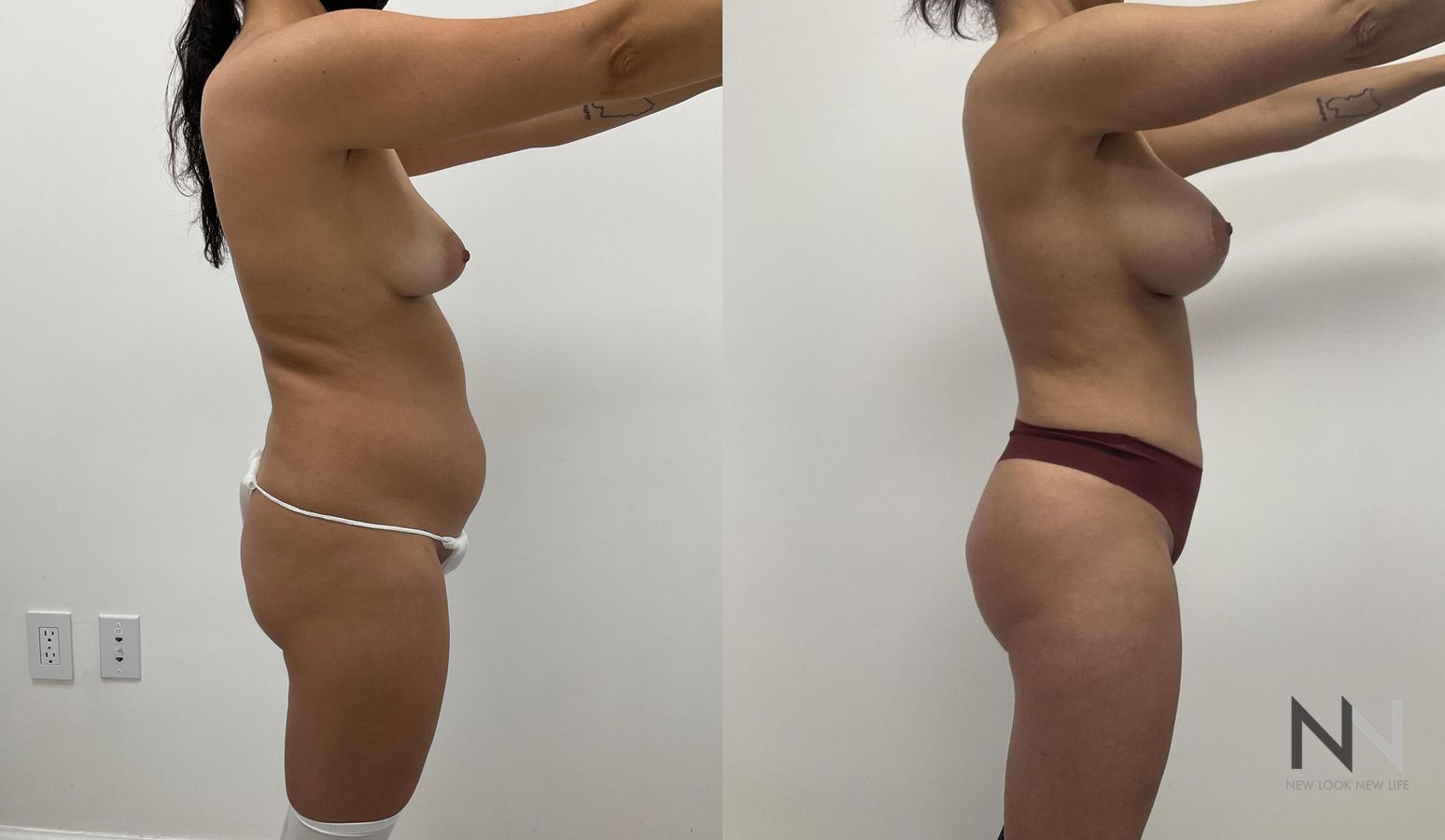 Before and after BBL and liposuction six months results - Angle 4