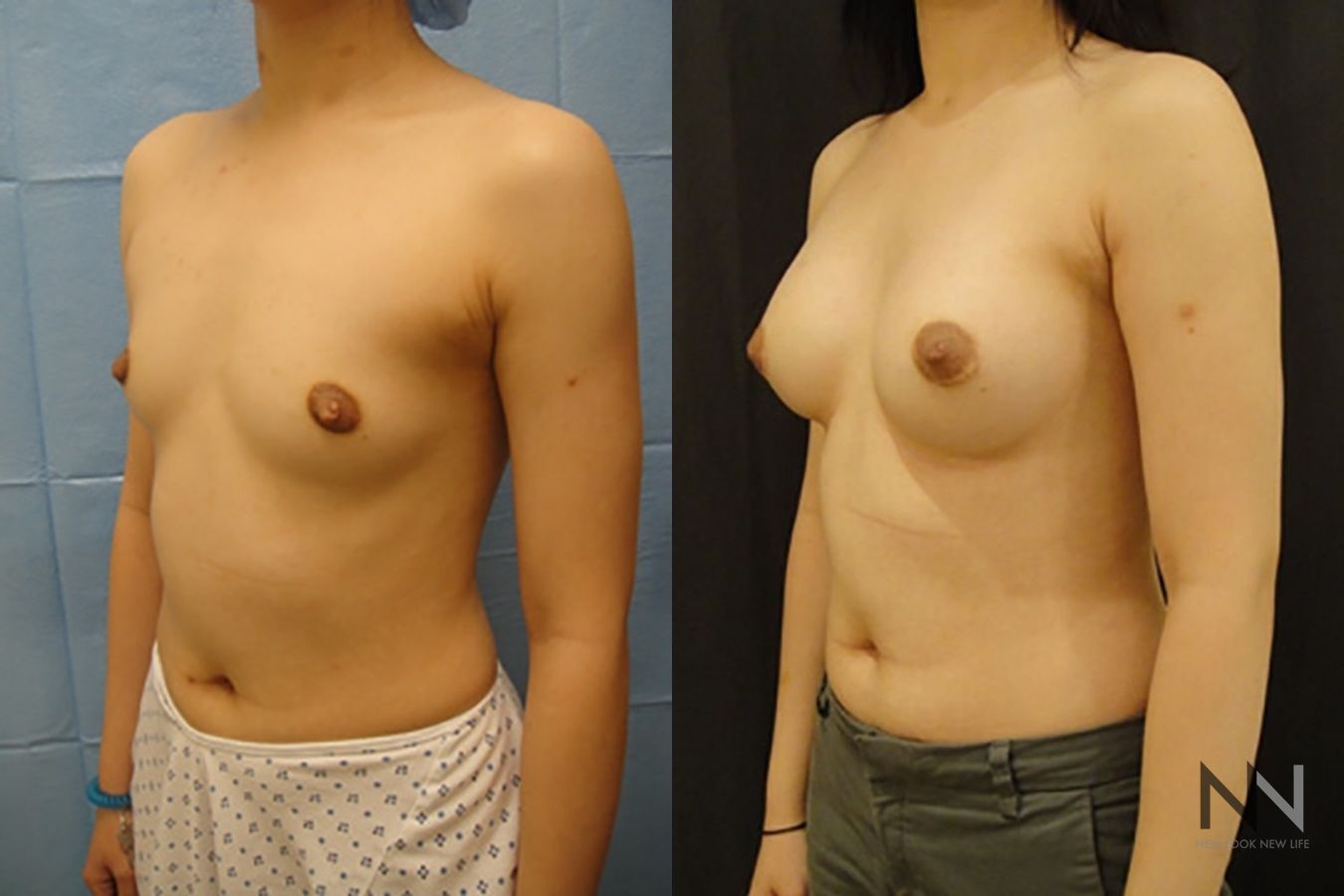 Breast augmentation results with improved projection - Angle 2