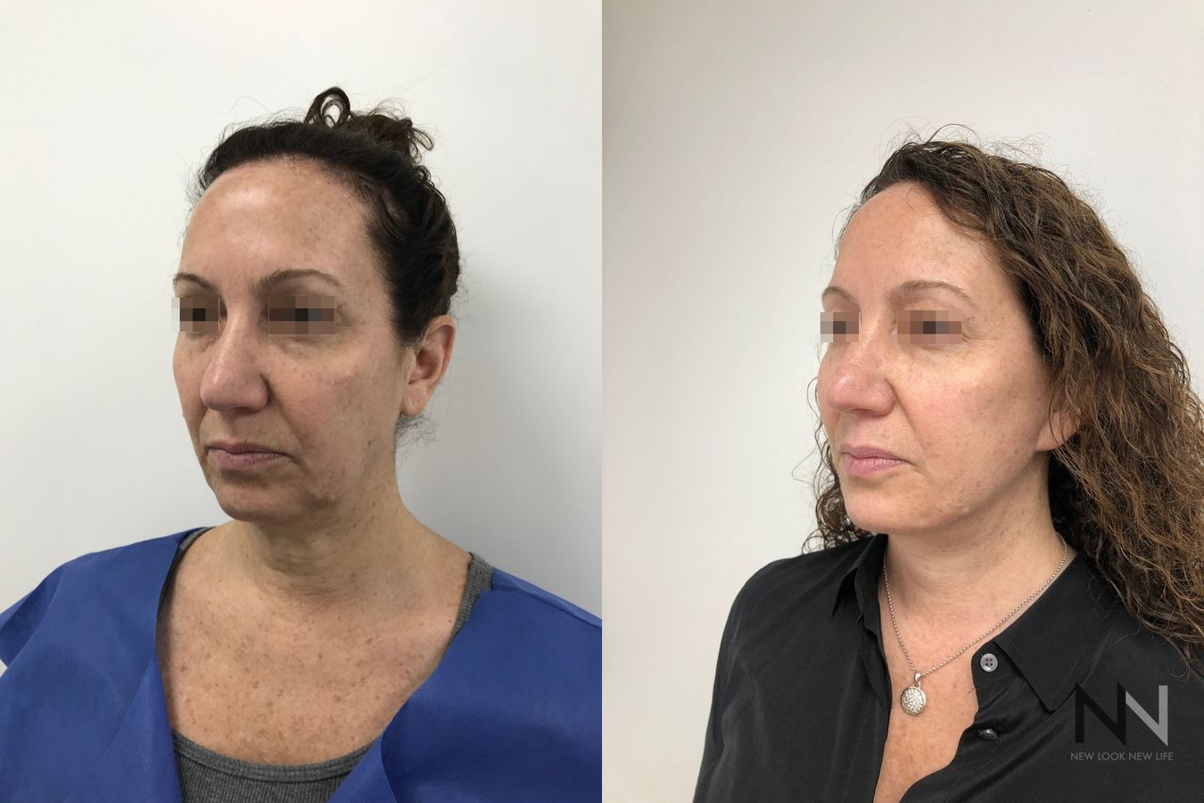 Mini facelift results six months post-op comparison - Angle 2