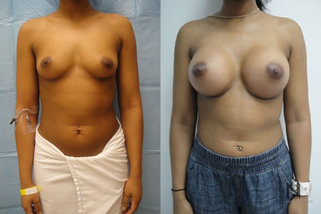 Breast implants showing increased volume and projection