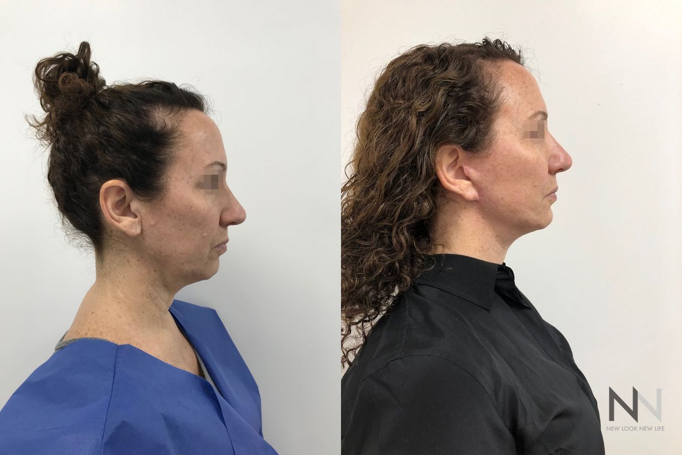 Mini facelift results six months post-op comparison - Angle 5