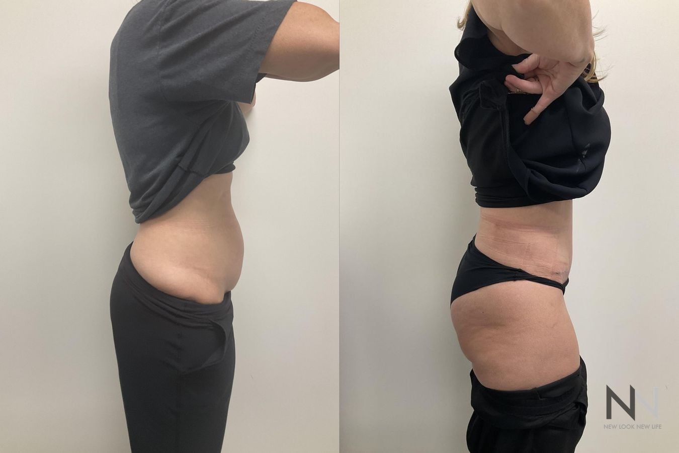 Waistline definition after abdominoplasty procedure - Angle 3