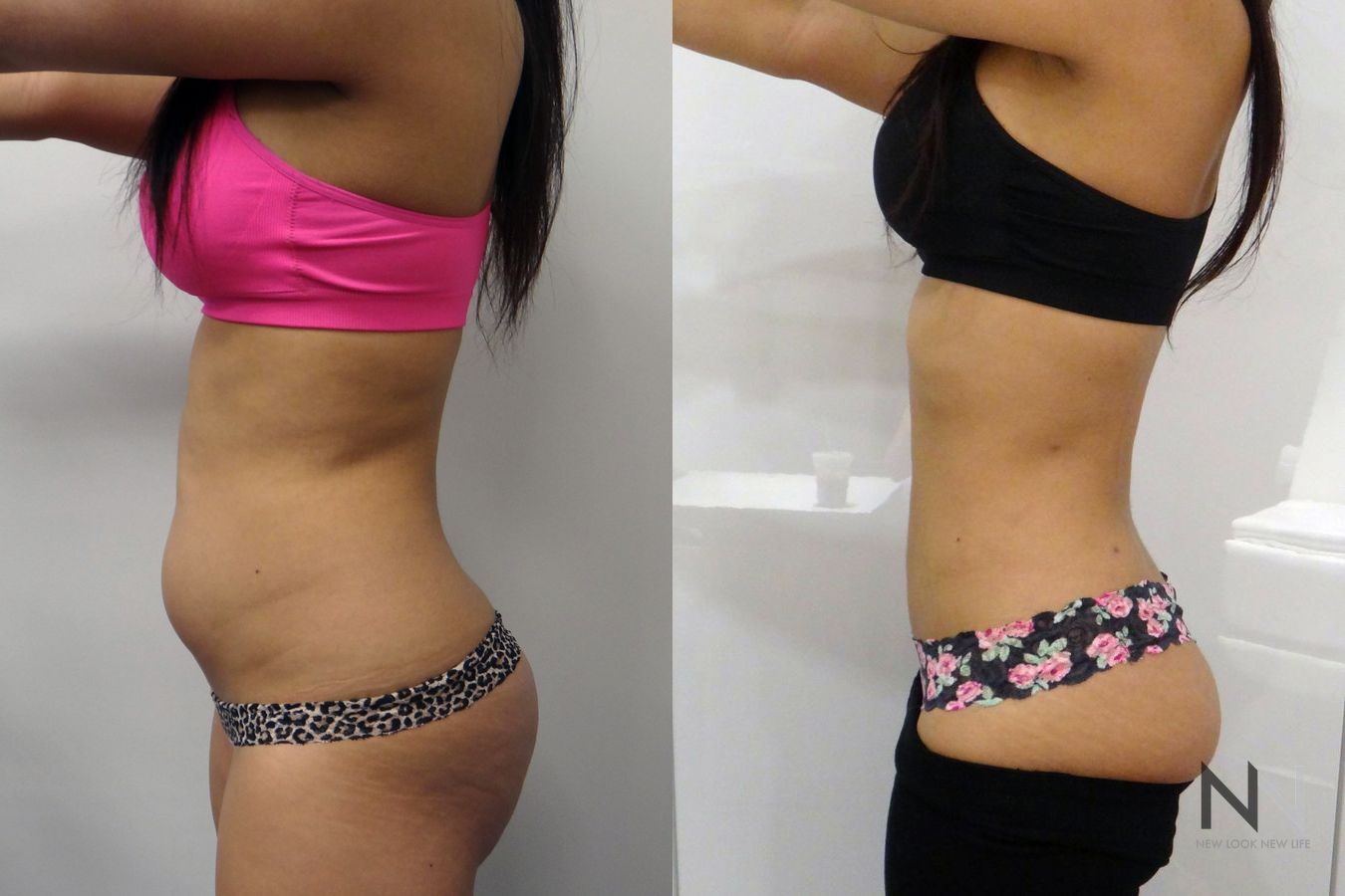 Awake liposuction showing improved waistline contour - Angle 3