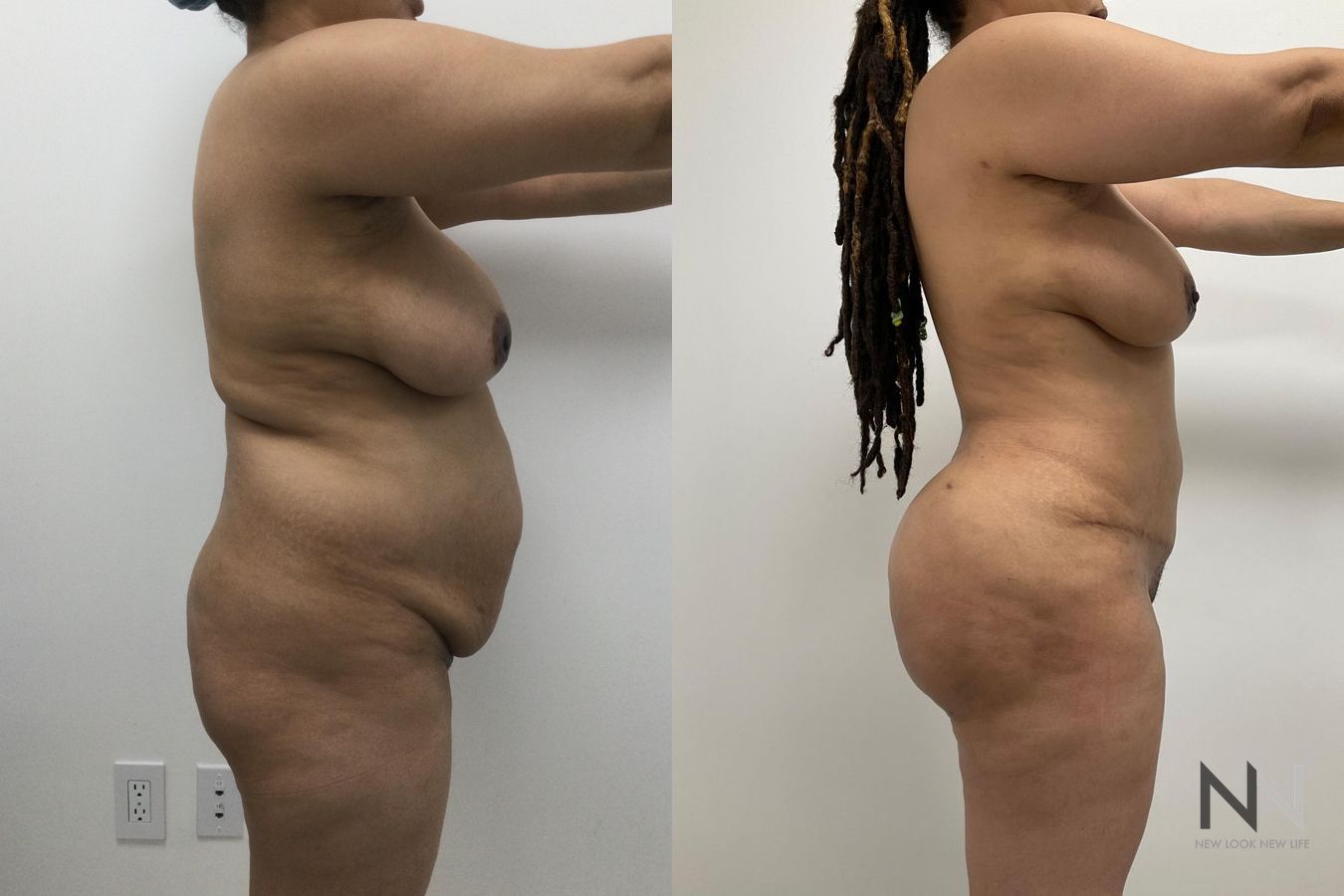 BBL showing increased buttock volume and contour - Angle 3
