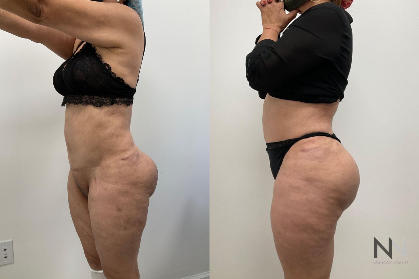 Before and after Brazilian Butt Lift showing enhanced buttock volume and improved projection six months after surgery. - Angle 3