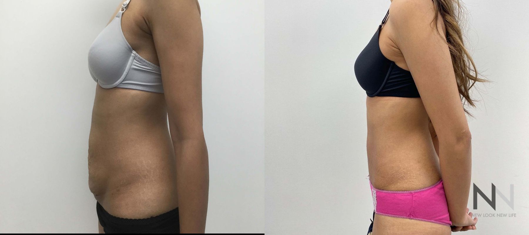 Before and after tummy tuck six months results - Angle 3