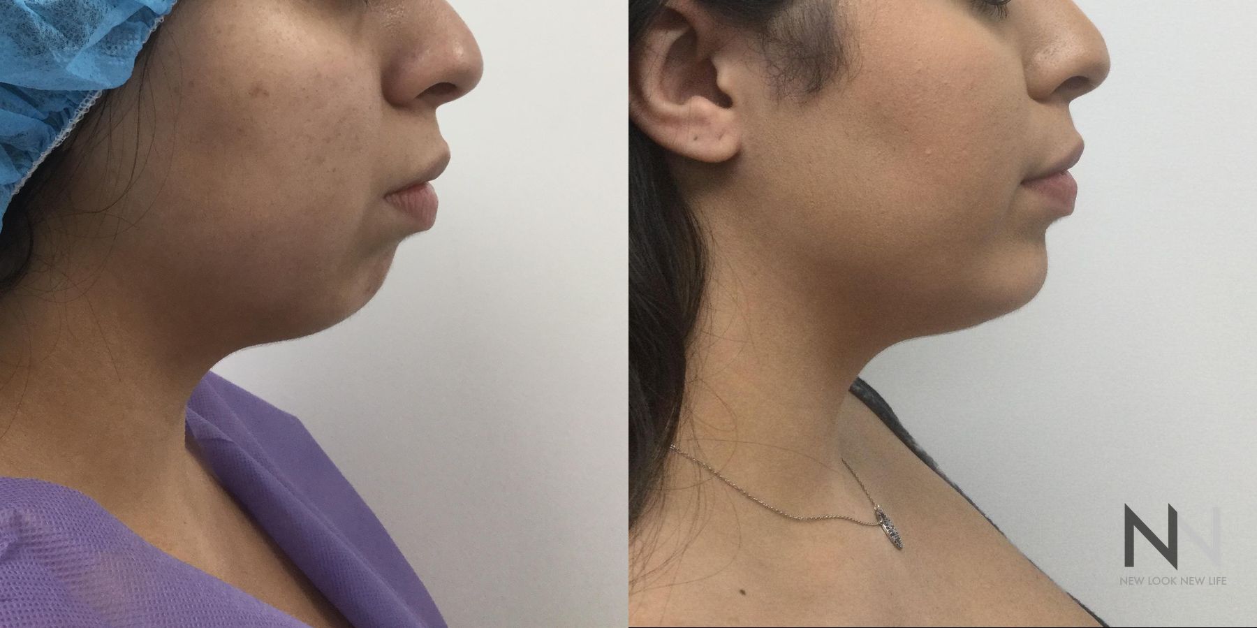 Chin augmentation before and after side profile comparison - Angle 2