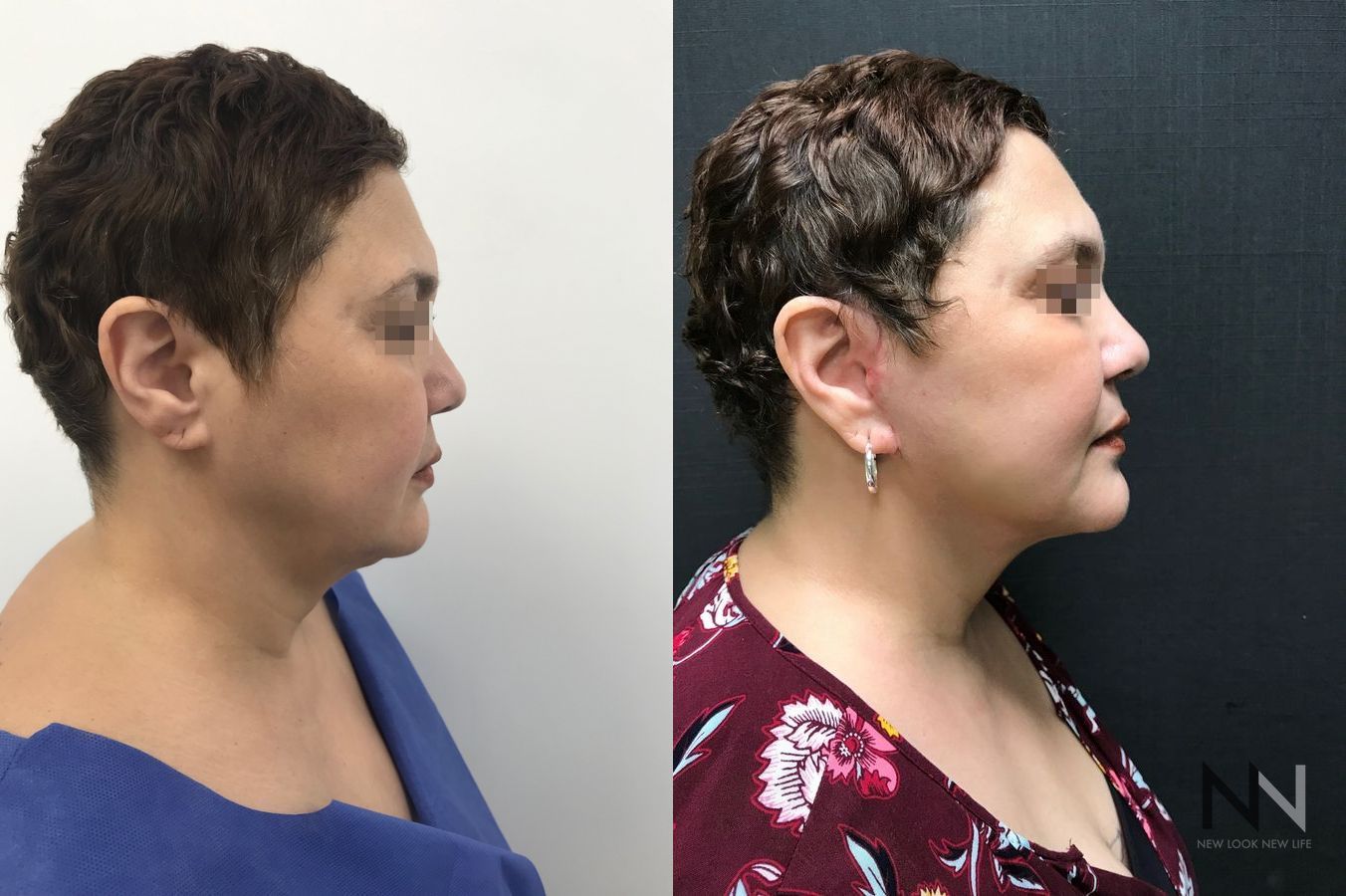 Before and after mini facelift and neck lift six months results - Angle 3