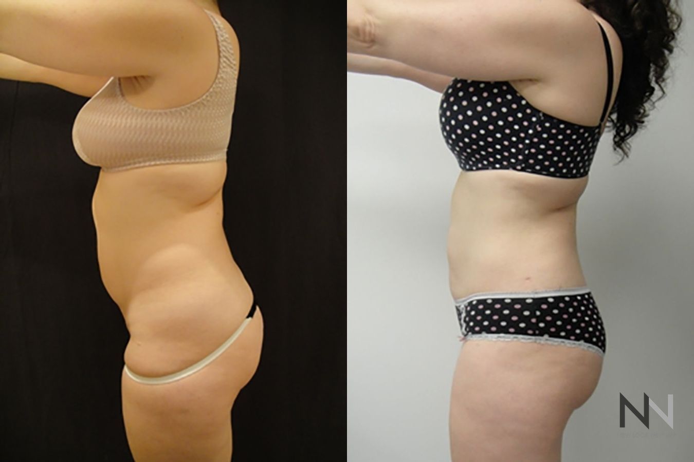 Before and after TICKLE liposuction flanks six months results - Angle 2
