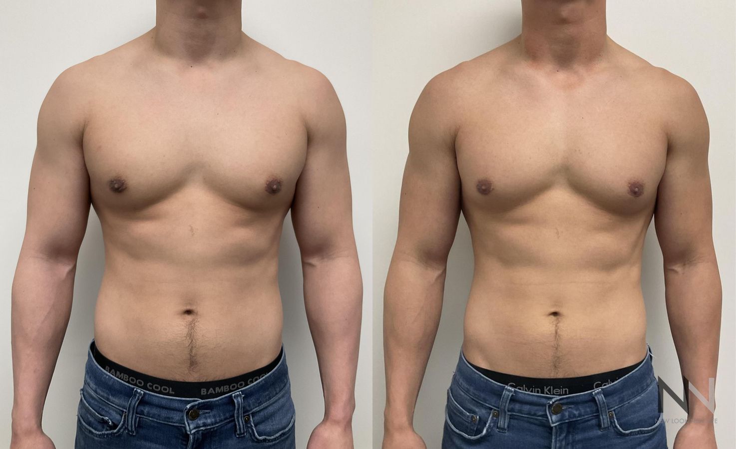 Gynecomastia surgery showing flatter chest contour - Angle 6