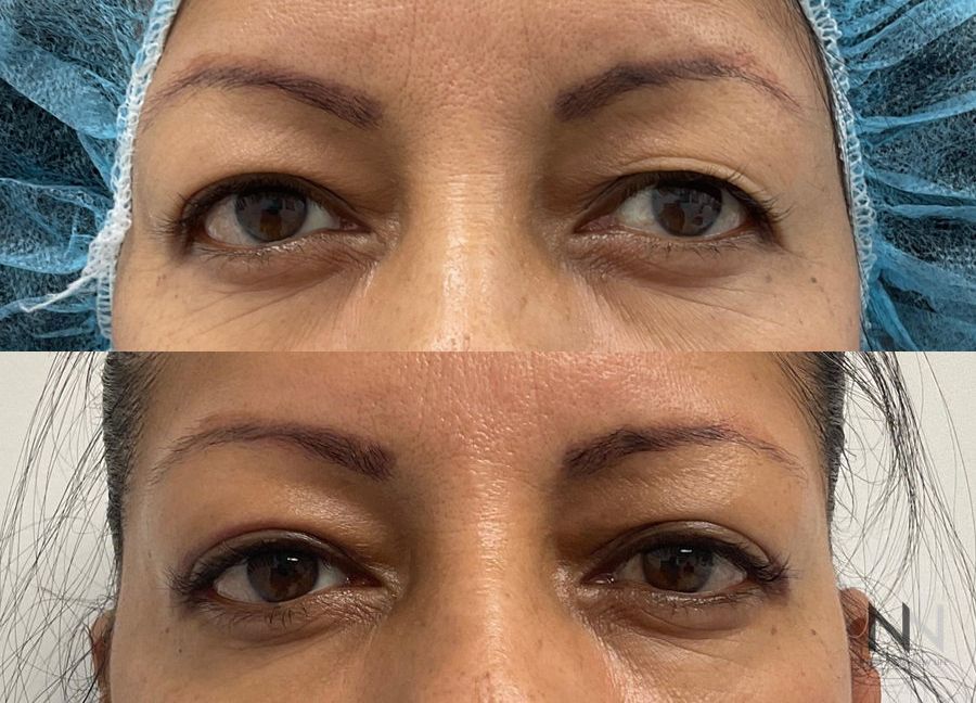 Upper blepharoplasty before and after eyelid contour improvement