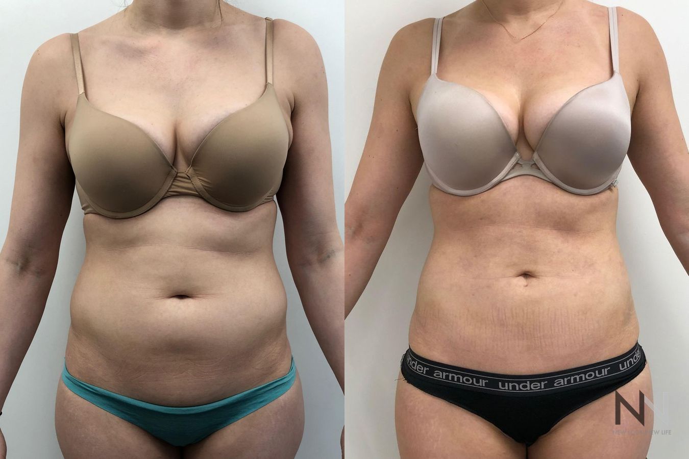 Awake liposuction abdomen and flank contour improvement