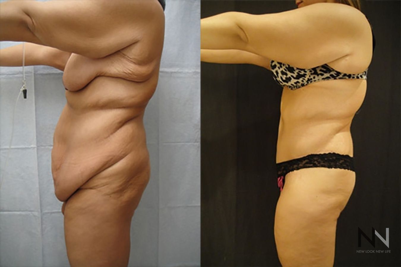 Abdominoplasty before and after showing flatter abdomen - Angle 2