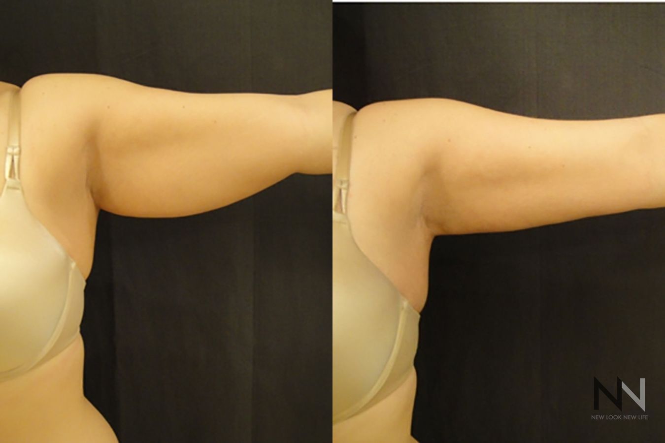Upper arm liposuction showing improved contour - Angle 2