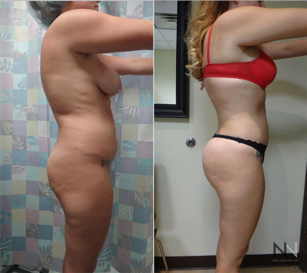 Before and after Brazilian Butt Lift six months results - Angle 3