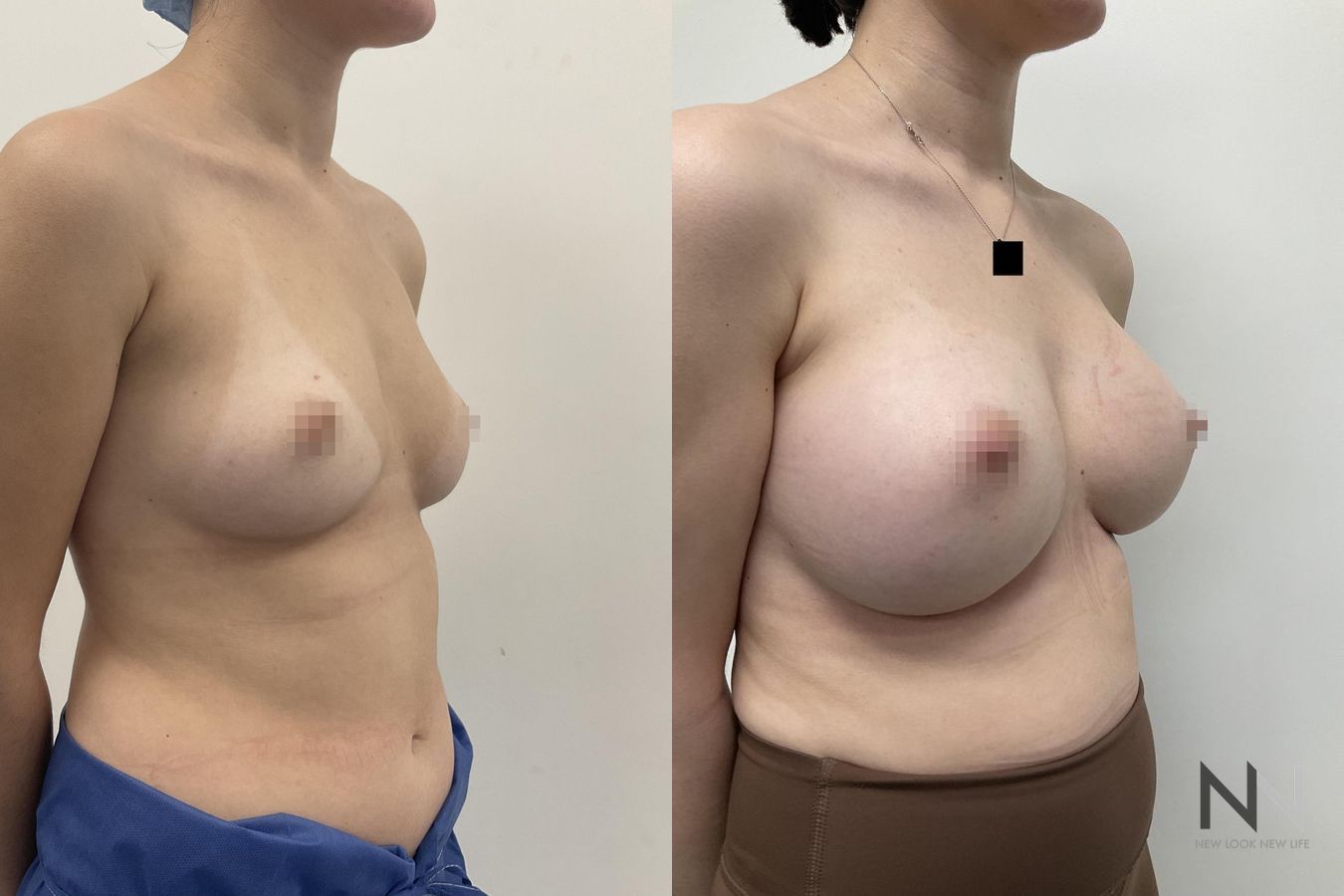 Before and after breast augmentation saline implants six months - Angle 4