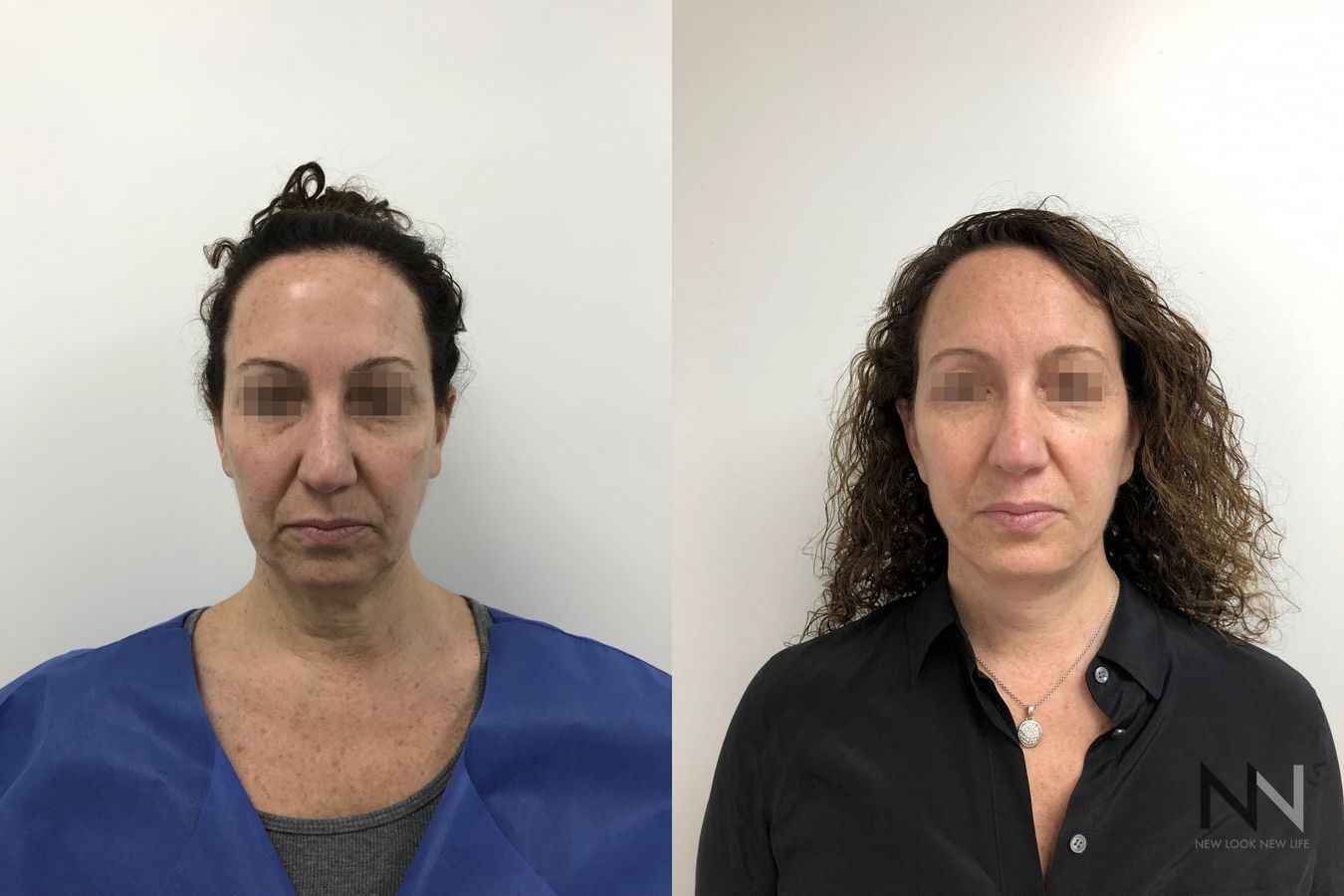 Mini facelift results six months post-op comparison