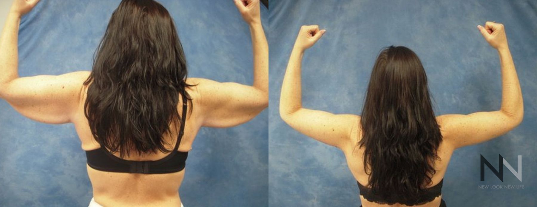 Before and after arm lift six months results - Angle 2