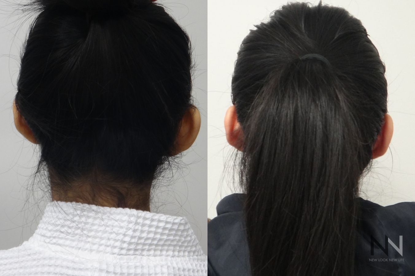 Prominent ears corrected with otoplasty surgery