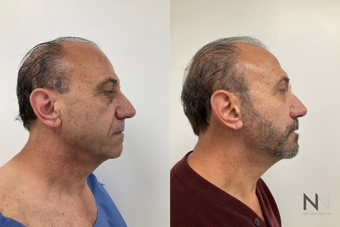 Before and after male facelift and neck lift six months results - Angle 3