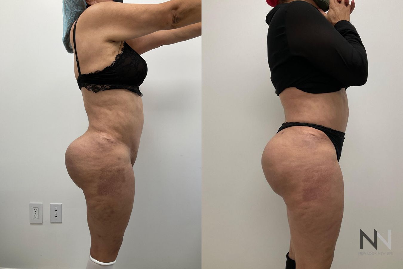 Before and after Brazilian Butt Lift showing enhanced buttock volume and improved projection six months after surgery. - Angle 2