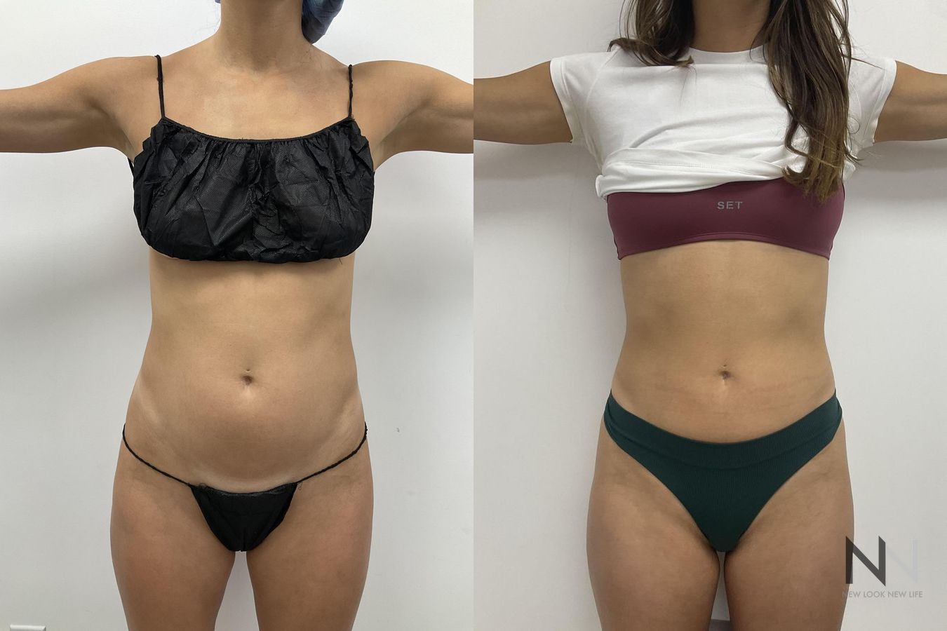 Liposuction of waist and abdomen showing improved contour