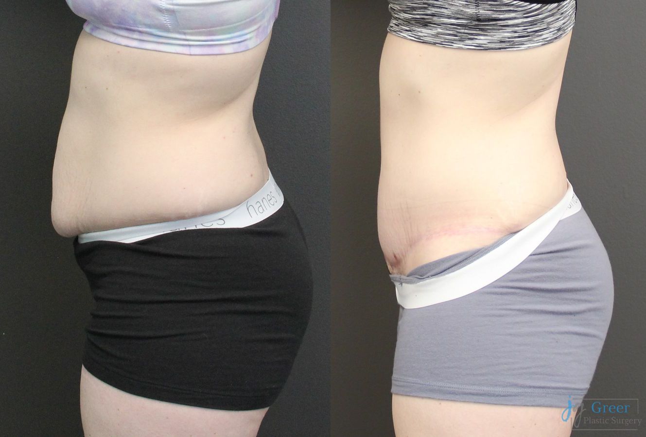 Before and after Abdominoplasty case 19842 - Angle 2