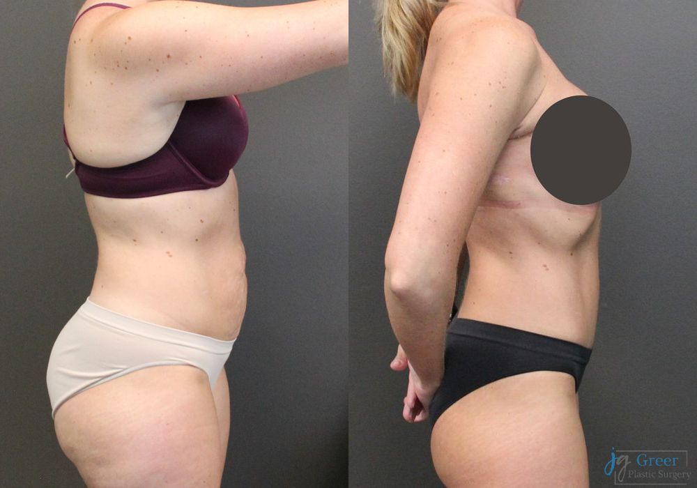 Abdominoplasty - Thumbnail 2