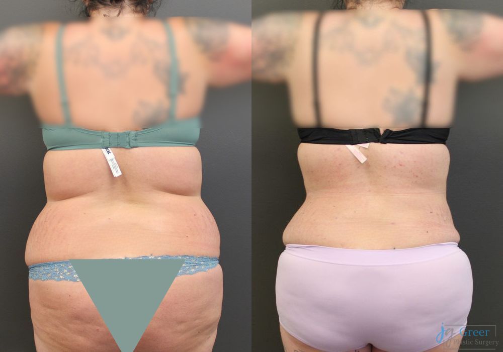 Abdominoplasty - Thumbnail 3