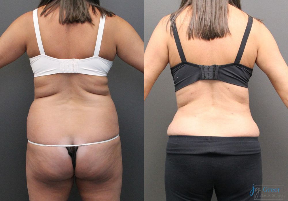 Abdominoplasty - Thumbnail 3