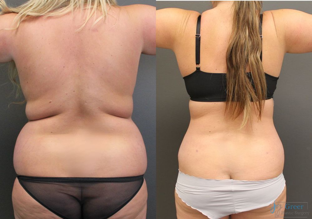 Abdominoplasty - Thumbnail 3