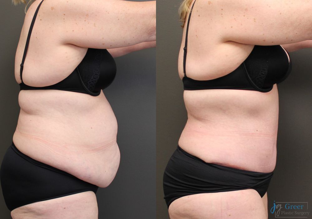 Before photo - Angle 2