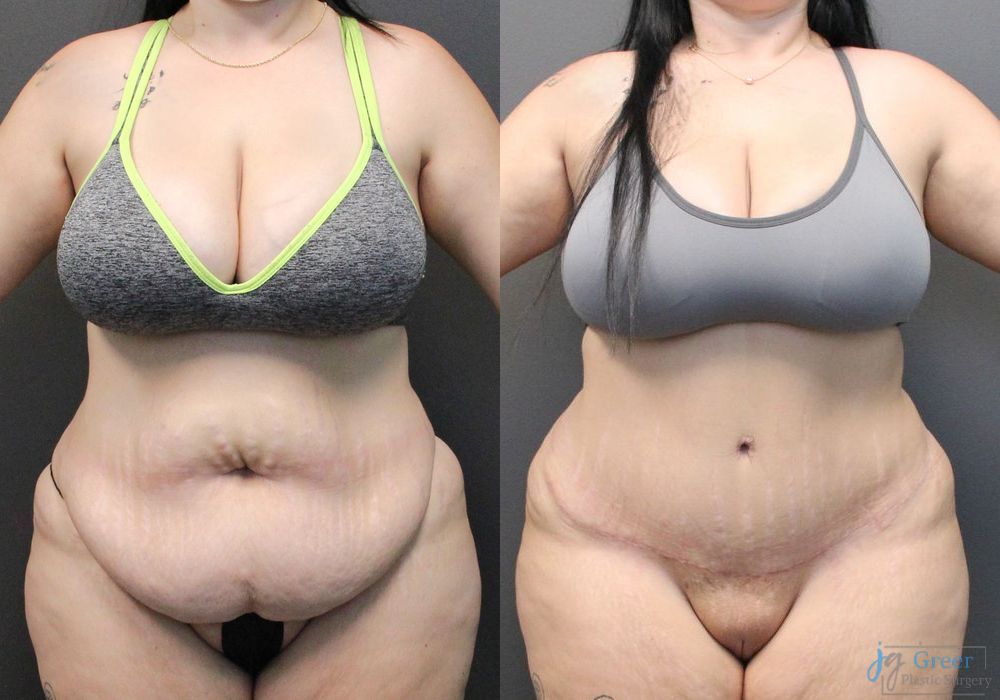 Abdominoplasty - Case 2296