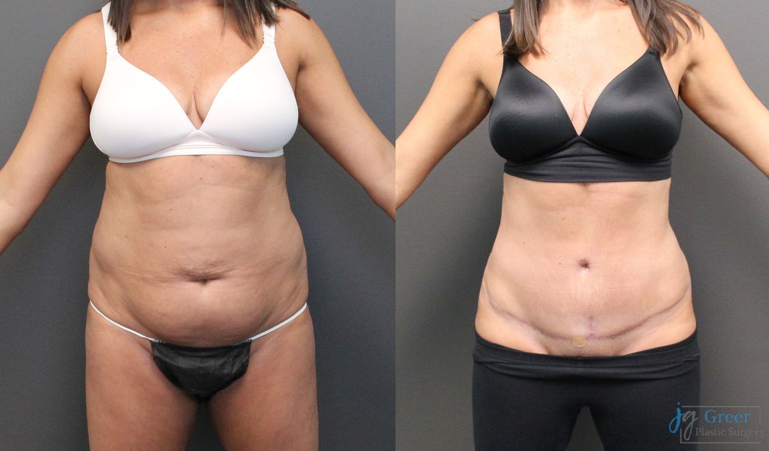Before and after Abdominoplasty case 19845