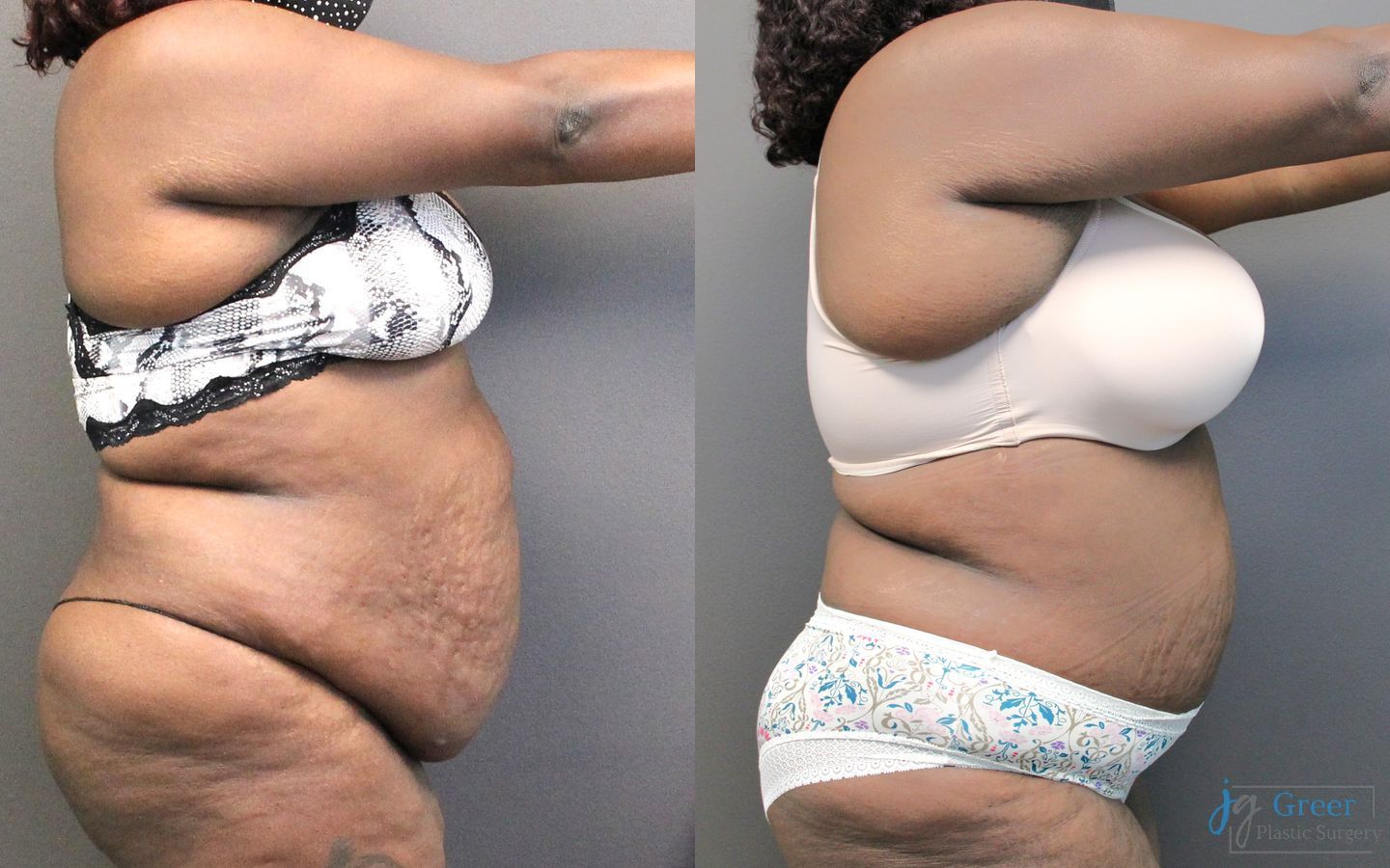 Before and after Abdominoplasty case 19848 - Angle 2