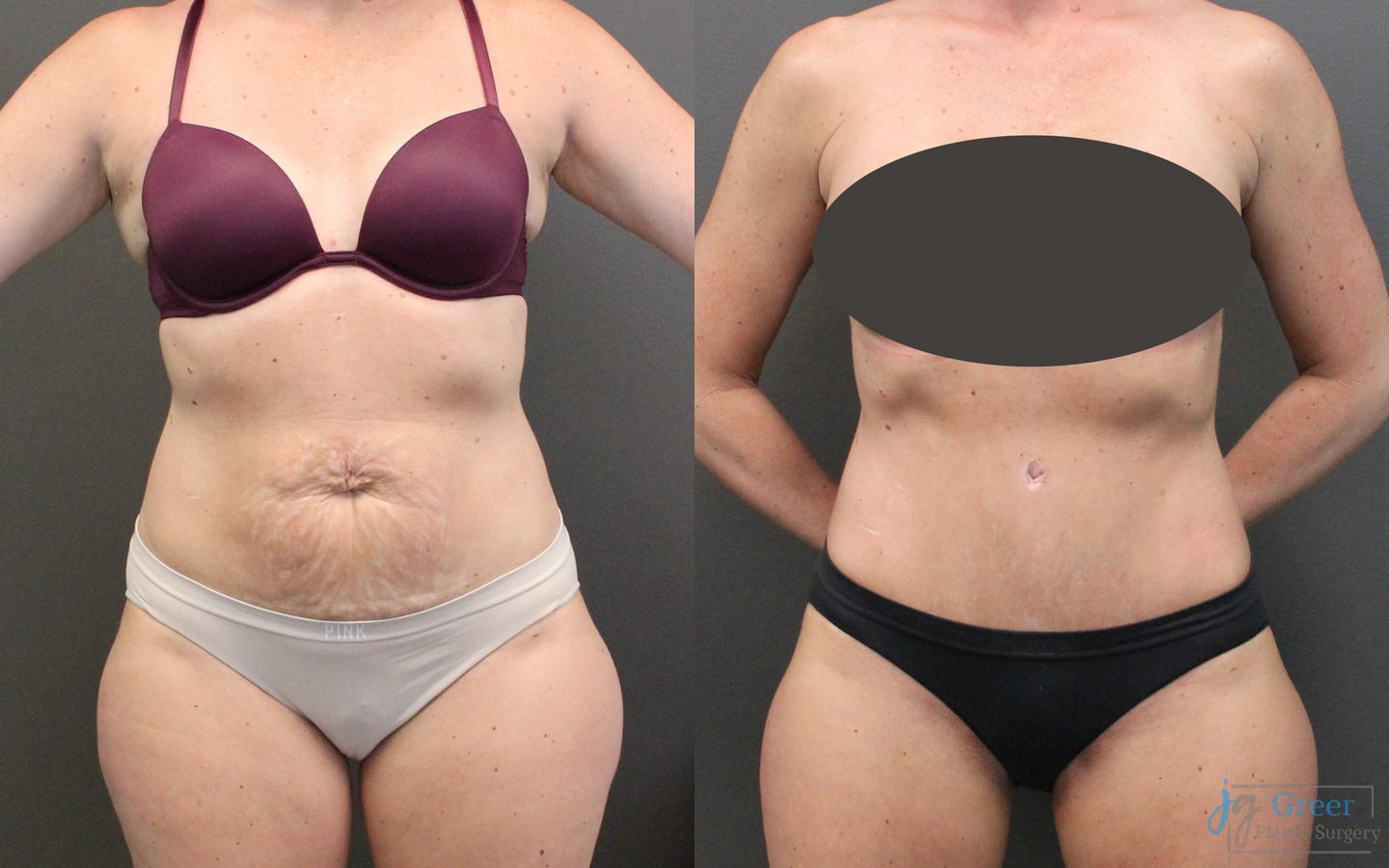Before and after Abdominoplasty case 19847