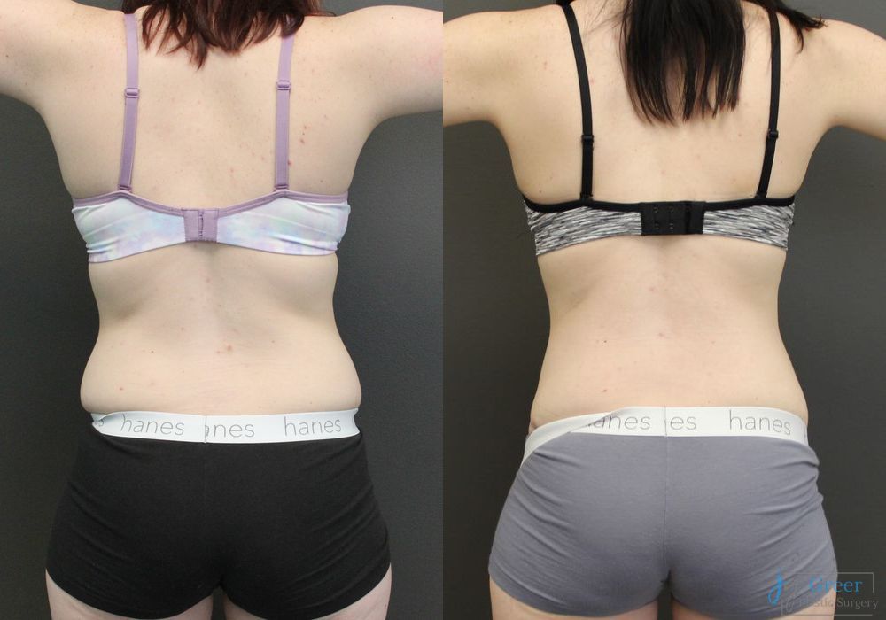 Abdominoplasty - Thumbnail 3