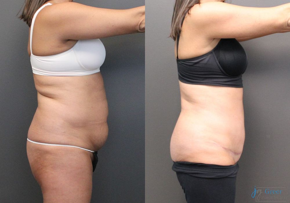 Abdominoplasty - Thumbnail 2