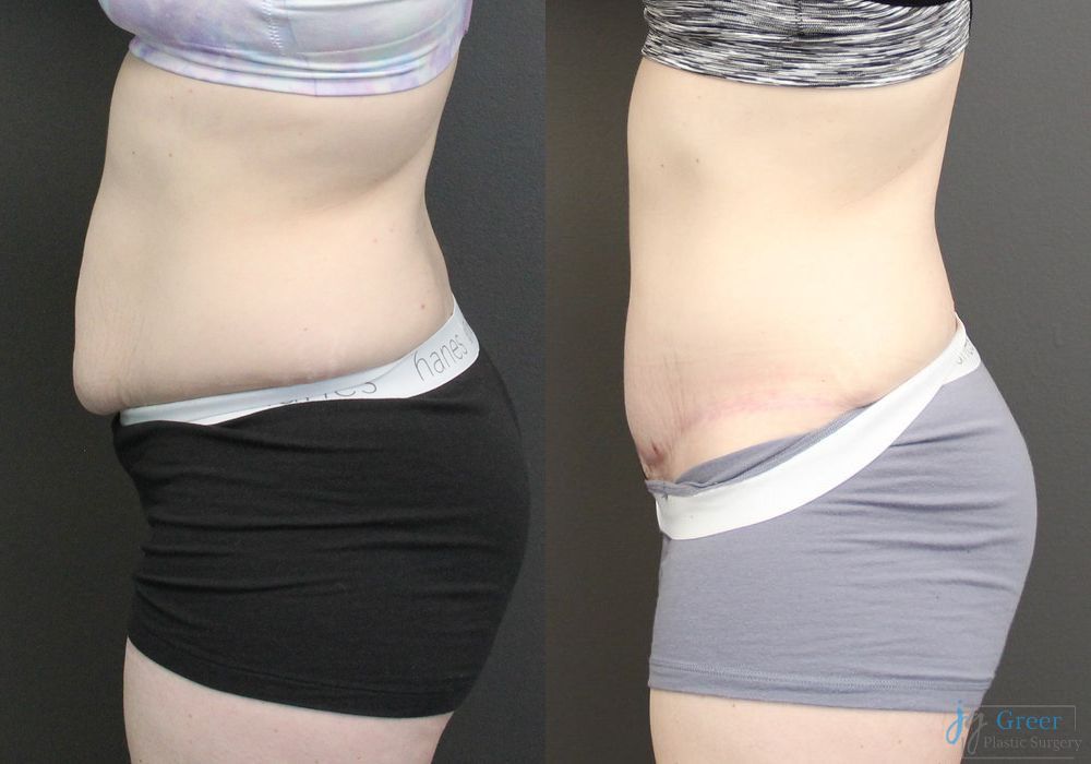 Abdominoplasty - Thumbnail 2