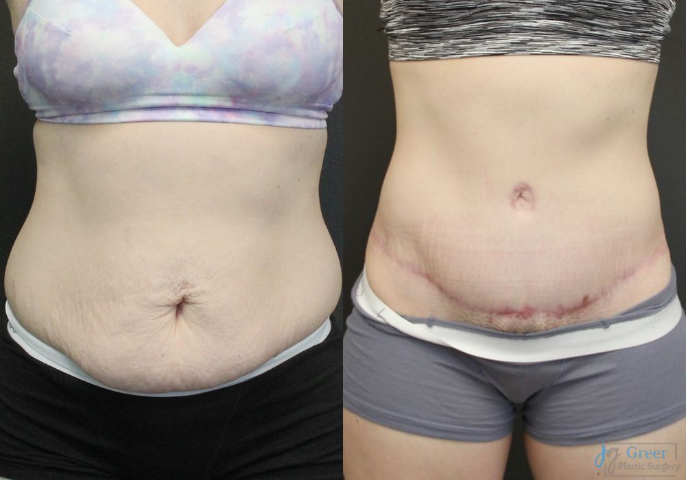 Abdominoplasty - Case 2292