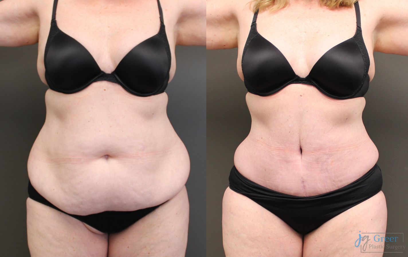 Before and after Abdominoplasty case 19839