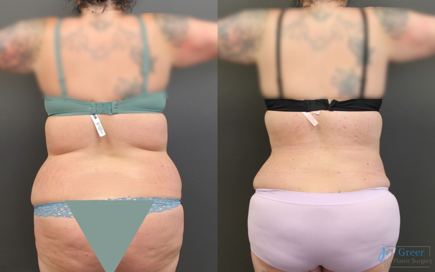 Before and after Abdominoplasty case 19844 - Angle 3