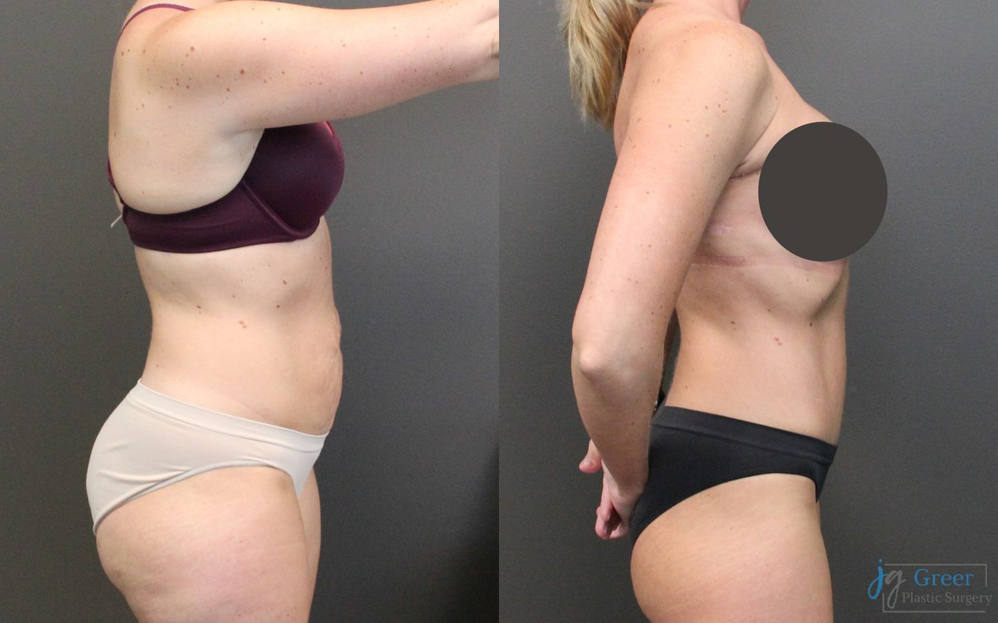 Before and after Abdominoplasty case 19847 - Angle 2