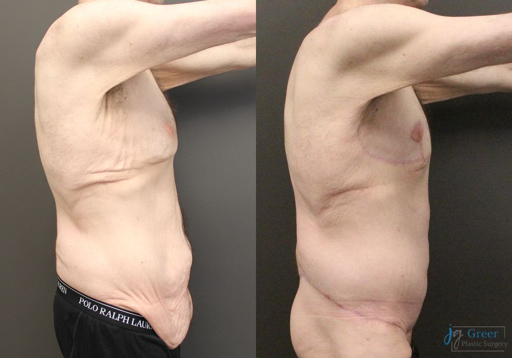 Fleur-de-Lis Abdominoplasty - Thumbnail 2