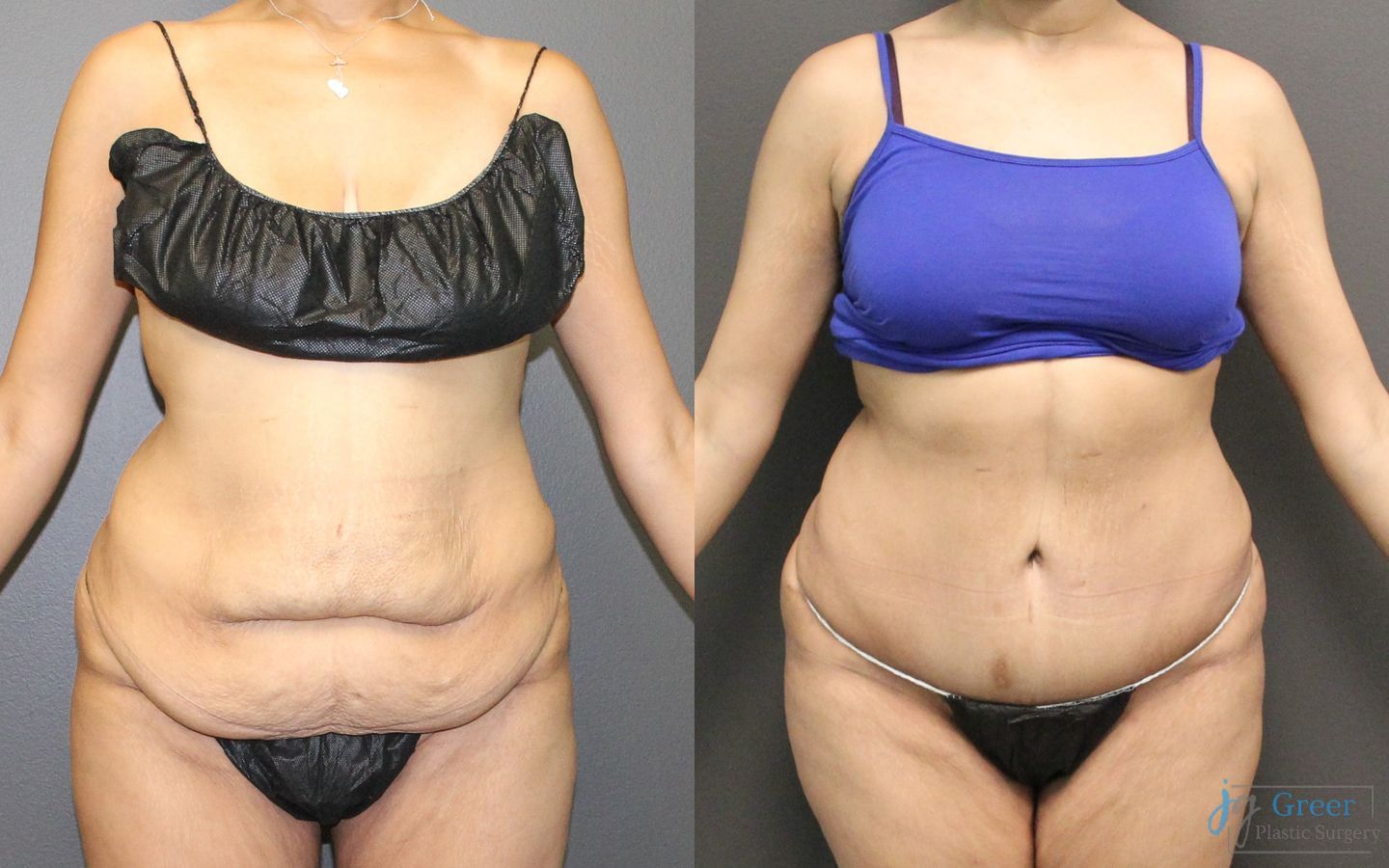 Before and after Abdominoplasty case 19849
